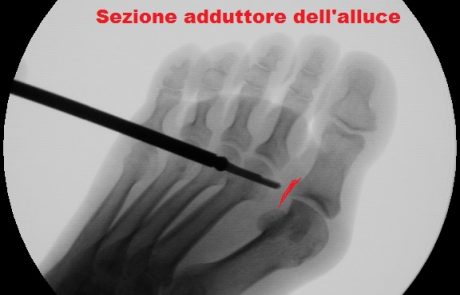 Sezione adduttore dell'alluce