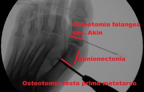 Osteotomia e Bunionectomia