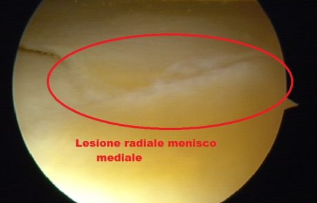 Lesiona radiale menisco mediale