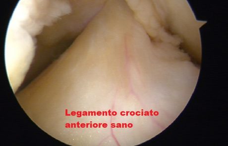 Legamento crociato anteriore sano