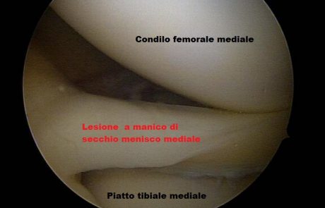Lesione a manico di secchio menisco mediale