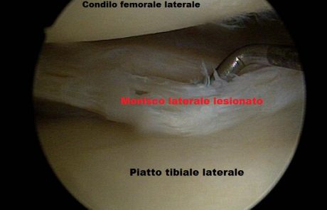 Menisco laterale lesionato