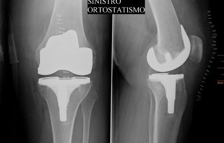 Protesi totale di ginocchio